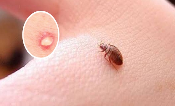 Bed Bugs Control